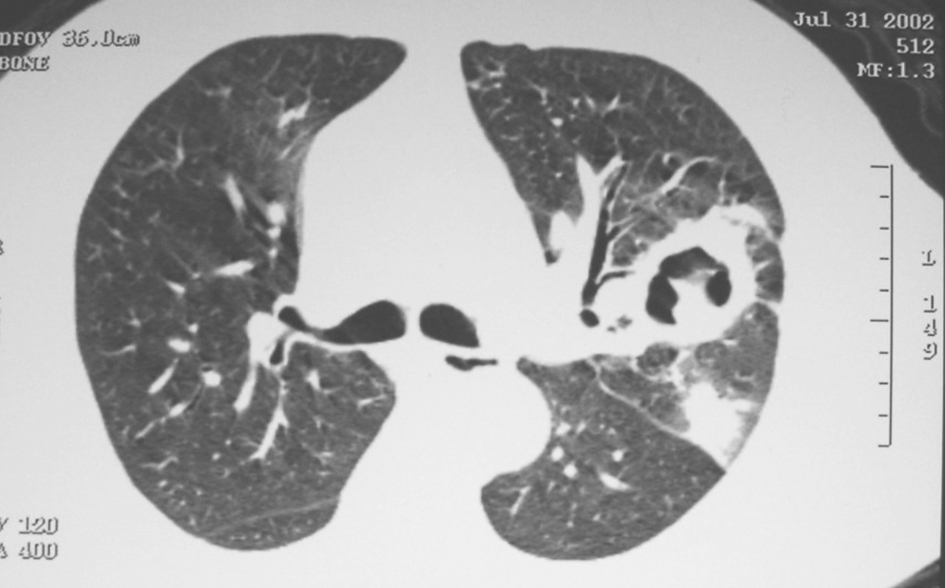 图3 左上肺曲霉菌胸部CT表现-d942153552c54b0cadcac9062b4fb9ab.jpg